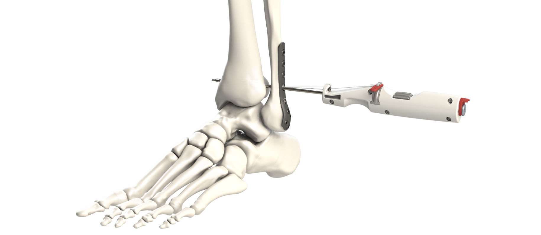 FLEX-FIX Syndesmosis System